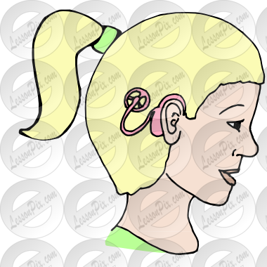 Cochlear Implants Picture