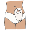Colostomy Pouch Picture